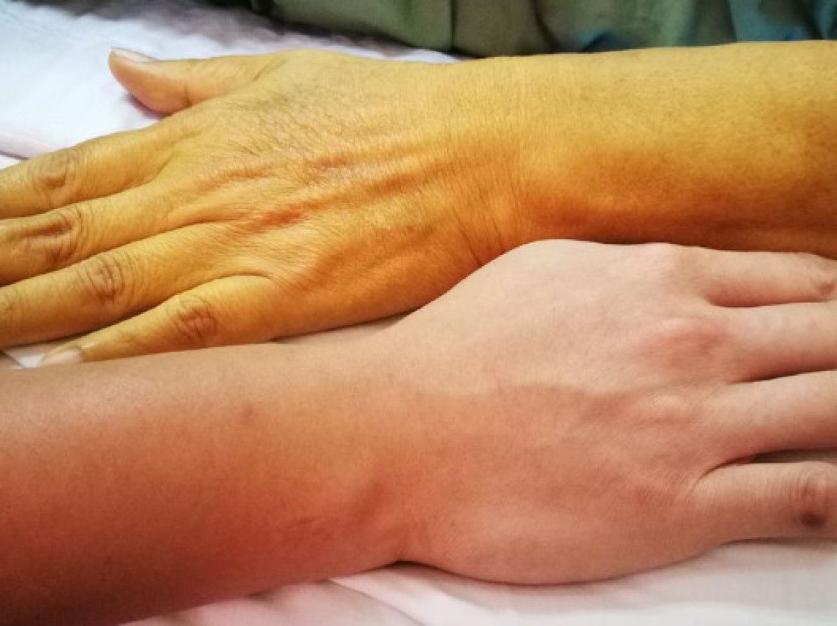 Bu 4 belirtiyi hafife almayın: Karaciğeriniz alarm veriyor olabilir