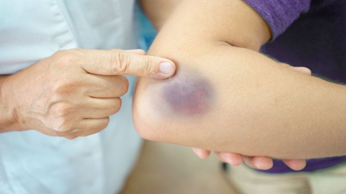 Uzmanlar açıkladı: Cildin kolay morarmasının sebebi buymuş