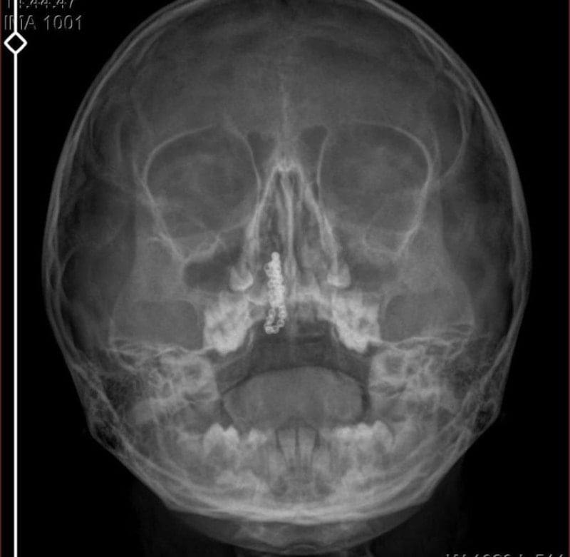 Rize’de 5 yaşındaki çocuğun burnundan tırnak makası zinciri çıktı